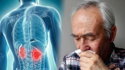 Ung thư tế bào thận là dạng ung thư khá phổ biến