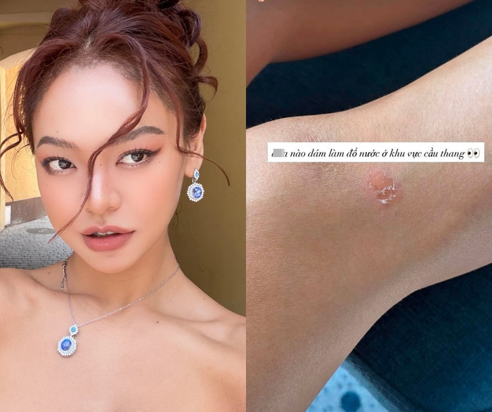 Mai Ngô bị thương trước phần thi Top Model ở Hoa hậu Siêu quốc gia.