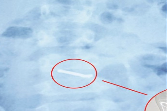 Bé trai 5 tuổi thủng ruột vì nam châm đồ chơi