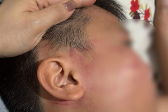 Học sinh lớp 4 bị giáo viên nước ngoài tát thủng màng nhĩ