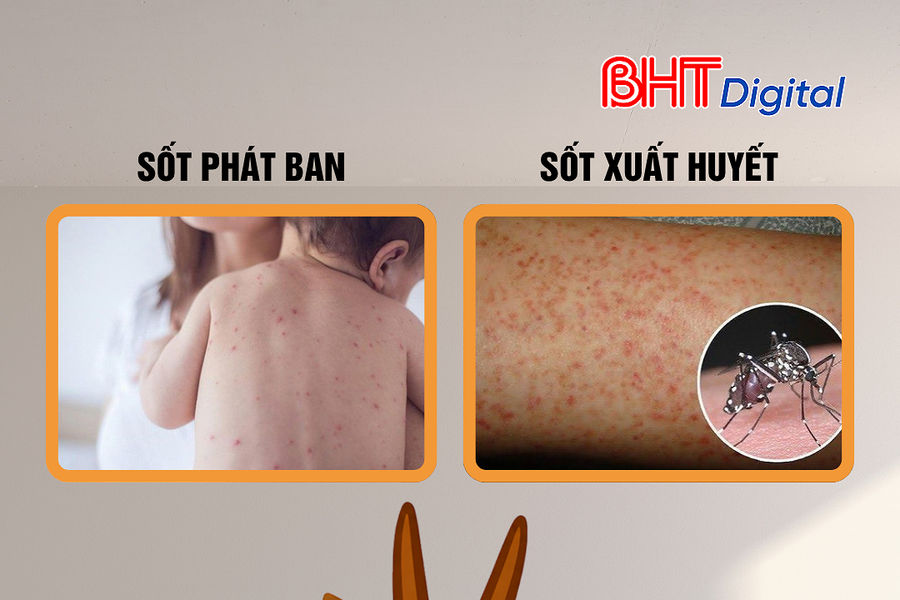 Sốt phát ban và sốt xuất huyết khác nhau thế nào?